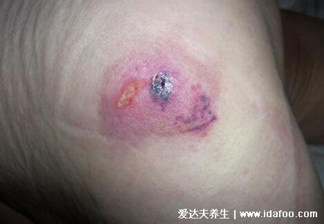 褥疮最早初期图片，轻微的红斑严重会化脓溃烂成洞