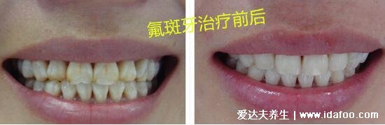 轻度氟斑牙图片及治疗法，牙齿发黄小心慢性氟中毒