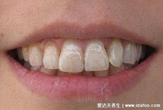 轻度氟斑牙图片及治疗法，牙齿发黄小心慢性氟中毒