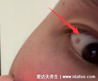 眼睛睑裂斑图片症状，眼白上有不痛不痒的淡黄色斑块