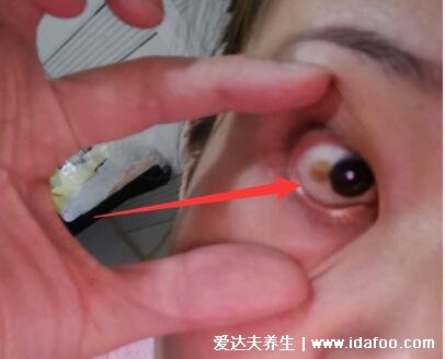眼睛睑裂斑图片症状，眼白上有不痛不痒的淡黄色斑块
