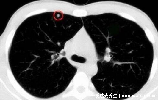 肺上结节80%是肺癌图片，警惕生长速度很快的结节(95%是良性)