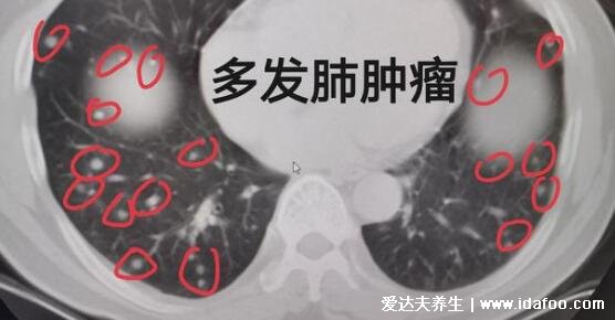 肺上结节80%是肺癌图片，警惕生长速度很快的结节(95%是良性)