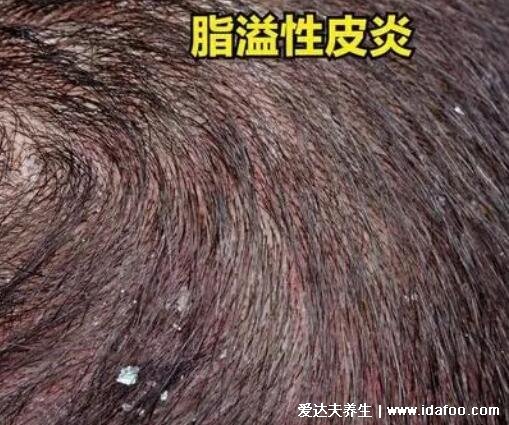 头皮上长小红疙瘩图片，可能是毛囊炎/溢脂性皮炎/头部牛皮藓