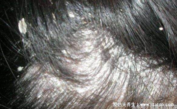 头皮上有白色大片的皮是怎么回事图片，头皮糠疹可造成脱发
