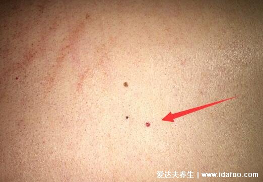 皮肤上有小红血点图片，警惕血痣/蜘蛛痣是肝病前兆(4种情况)