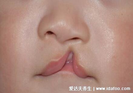 唇腭裂图片是什么样子图片，1侧或2边嘴巴开裂(孕早期要预防)