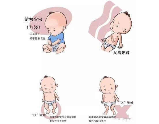 婴儿佝偻病睡姿图片，警惕骨骼发育的4种情况(平躺睡觉) 