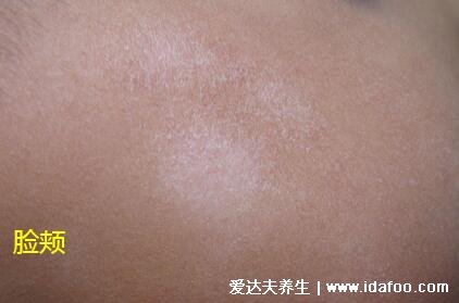 白色糠疹初期图片，白斑表面有灰白色磷屑(和白癜风区分)