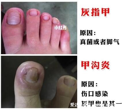 甲沟炎图片和灰指甲的区别图片，甲沟炎指甲长在肉里穿鞋疼