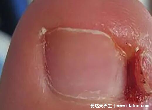 甲沟炎图片和灰指甲的区别图片，甲沟炎指甲长在肉里穿鞋疼