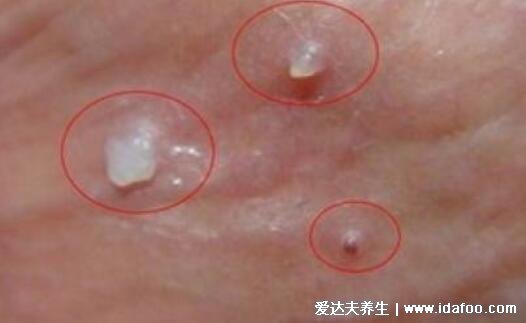 女人艾滋病最明显特征，长小红点/生殖器疱疹(三大症状图片)