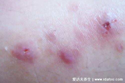 花柳病初期皮疹图片及症状，梅毒/淋病/尖锐湿疣/生殖器疱疹