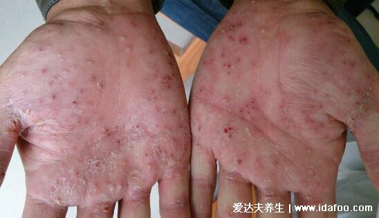 掌跖脓疱病初期图片及治疗法，皮疹和脓疱伴随剧烈瘙痒灼痛