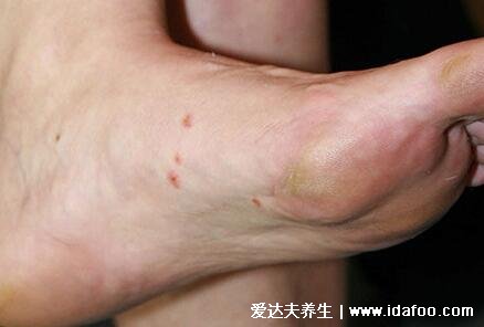 掌跖脓疱病初期图片及治疗法，皮疹和脓疱伴随剧烈瘙痒灼痛