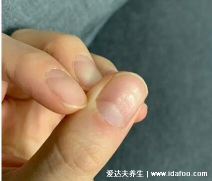 大拇指指甲凹陷图片与疾病，不要惊慌多是缺铁性贫血(4种情况)