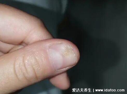 大拇指指甲凹陷图片与疾病，不要惊慌多是缺铁性贫血(4种情况)