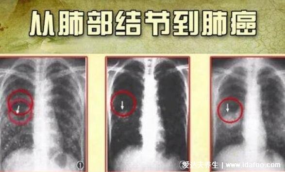 肺部结节最怕三个征兆，警惕磨玻璃样的结节(5%会癌变)