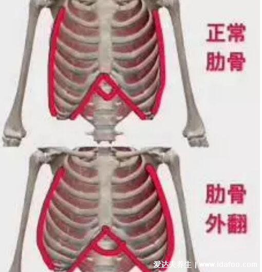 肋骨外翻图片对比，可影响外观出现鸡胸及器官的受损