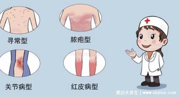 银屑病图片初期症状，红疹有白屑薄膜出血点(不同类型图片) 