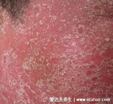 银屑病图片初期症状，红疹有白屑薄膜出血点(不同类型图片) 