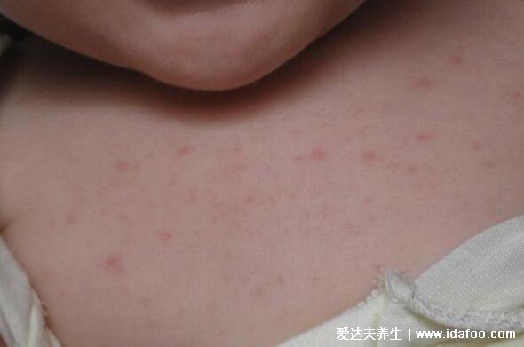 湿疹图片初期症状图片，6种类型慢性湿疹最难治(附治疗方法)