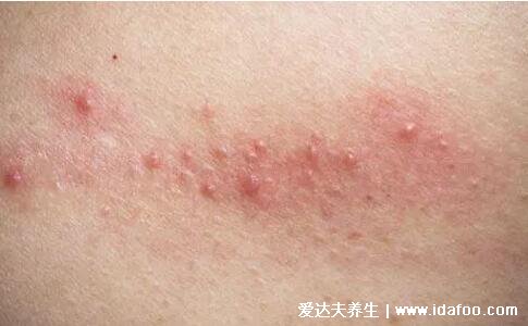 过敏性皮炎图片和症状，大片瘙痒红肿的皮疹风团(夜间更痒)