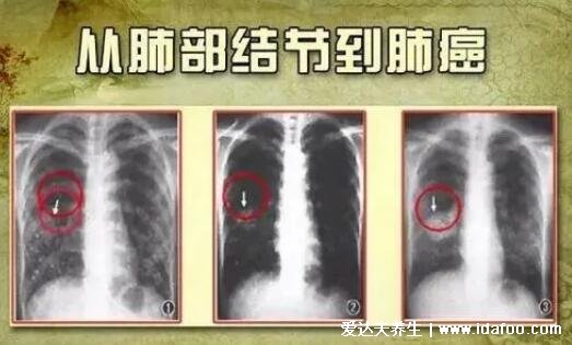 肺部结节最怕三个征兆，持续性咳嗽警惕癌变(肺癌早期三处痛)