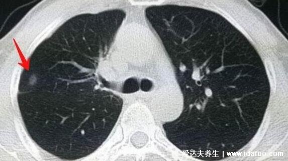 肺部结节最怕三个征兆，持续性咳嗽警惕癌变(肺癌早期三处痛)
