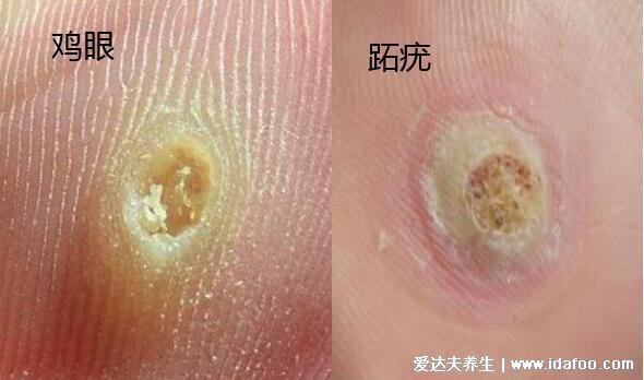 跖疣初期图片及症状，表面有黑点的疼痛丘疹(附和鸡眼的区别图)