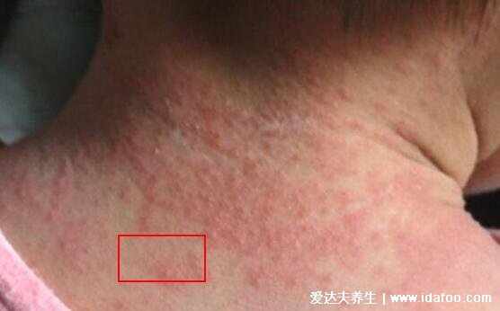 痱子和湿疹的区别图片，后脑勺、在患处有红色的丘疹，夏天天气炎热，婴幼儿的湿疹可能是生理反应，病因</strong></p><p><img dir="2ca779" alt=