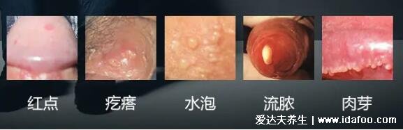 早期龟头炎症状图片对照，长红点水疱会瘙痒溃烂(6种类型)