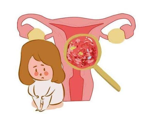 女性宫颈癌一般三处痒，面部/外阴/YD(附早期宫颈癌分泌物图片)