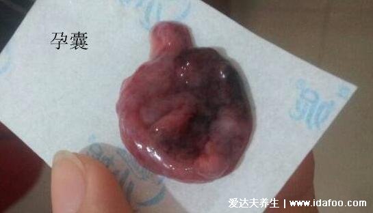 流产掉下来的完整孕囊图片，有肉感的粉白囊状物(胆小慎入)