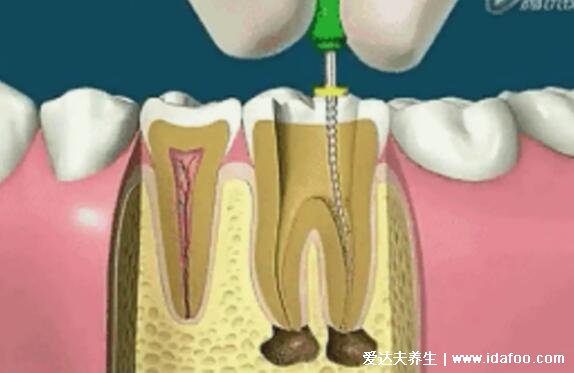 根管治疗后悔一辈子，治疗后不做牙冠隐患大/小心牙齿碎裂