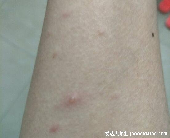 水痘初期症状图片，头躯干先出/数小时丘疹变为疱疹(先发热) 