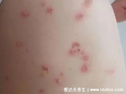 水痘初期症状图片，头躯干先出/数小时丘疹变为疱疹(先发热) 