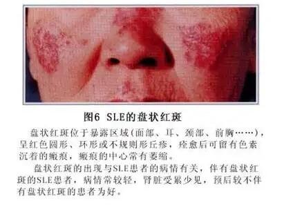 初期红斑狼疮早期症状图片，脸颊蝶状红斑不痒(15到40女性)
