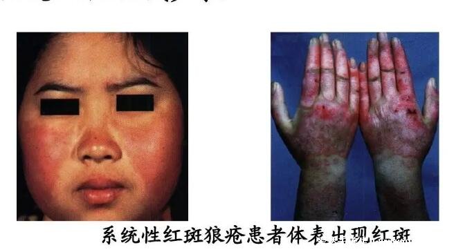初期红斑狼疮早期症状图片，脸颊蝶状红斑不痒(15到40女性)