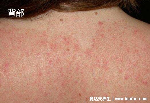 皮炎和湿疹的区别图片，皮炎多是红斑水肿长水疱