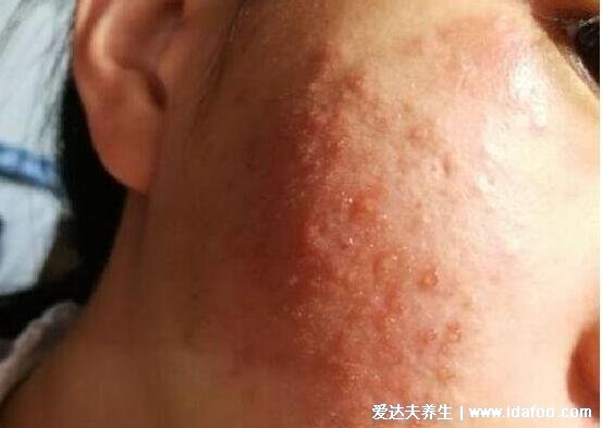 皮炎和湿疹的区别图片，皮炎多是红斑水肿长水疱