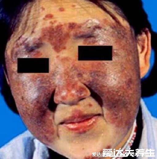 红斑狼疮早期10个征兆，面部蝶形红斑/口腔溃疡典型症状(图片)