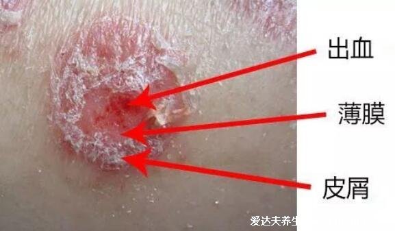 牛皮肤癣的症状图片，丘疹变红斑有磷屑薄膜出血点(治疗方法)