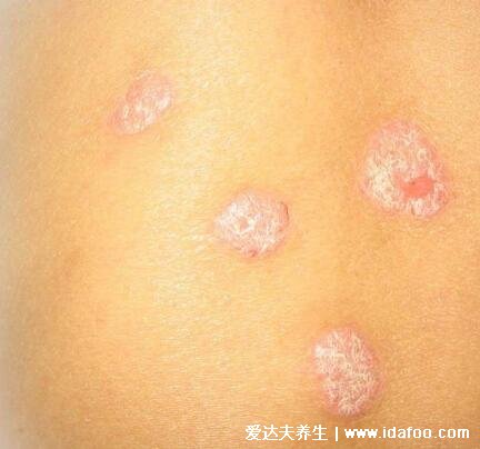 牛皮肤癣的症状图片，丘疹变红斑有磷屑薄膜出血点(治疗方法)