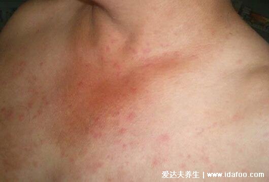 初期日光性皮炎症状图片，像晒伤皮肤红肿长皮疹水泡(附治疗法)
