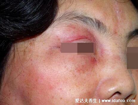 初期日光性皮炎症状图片，像晒伤皮肤红肿长皮疹水泡(附治疗法)