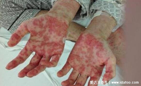 白血病初期小红点图片，警惕紫红色瘀斑或丘疹结节(附早期症状)
