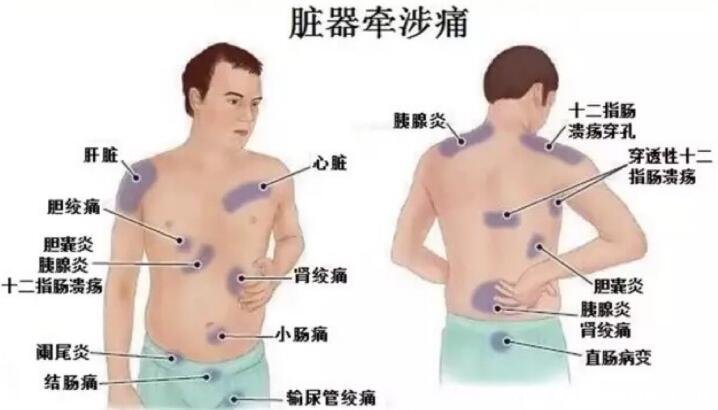 后背疼痛要警惕的三种病，小心后背偏下消化系统病(位置示意图)