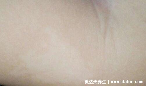 手臂白斑最初期的图片，白癜风不疼不痒边界清楚(5种类型白斑)