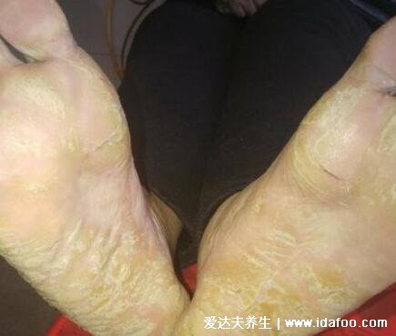 脚气图片水泡型初期症状，有水疱清亮疱液不要挑破(夏季多发)